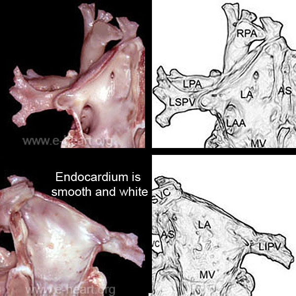 Left atrium anterior and posterior views